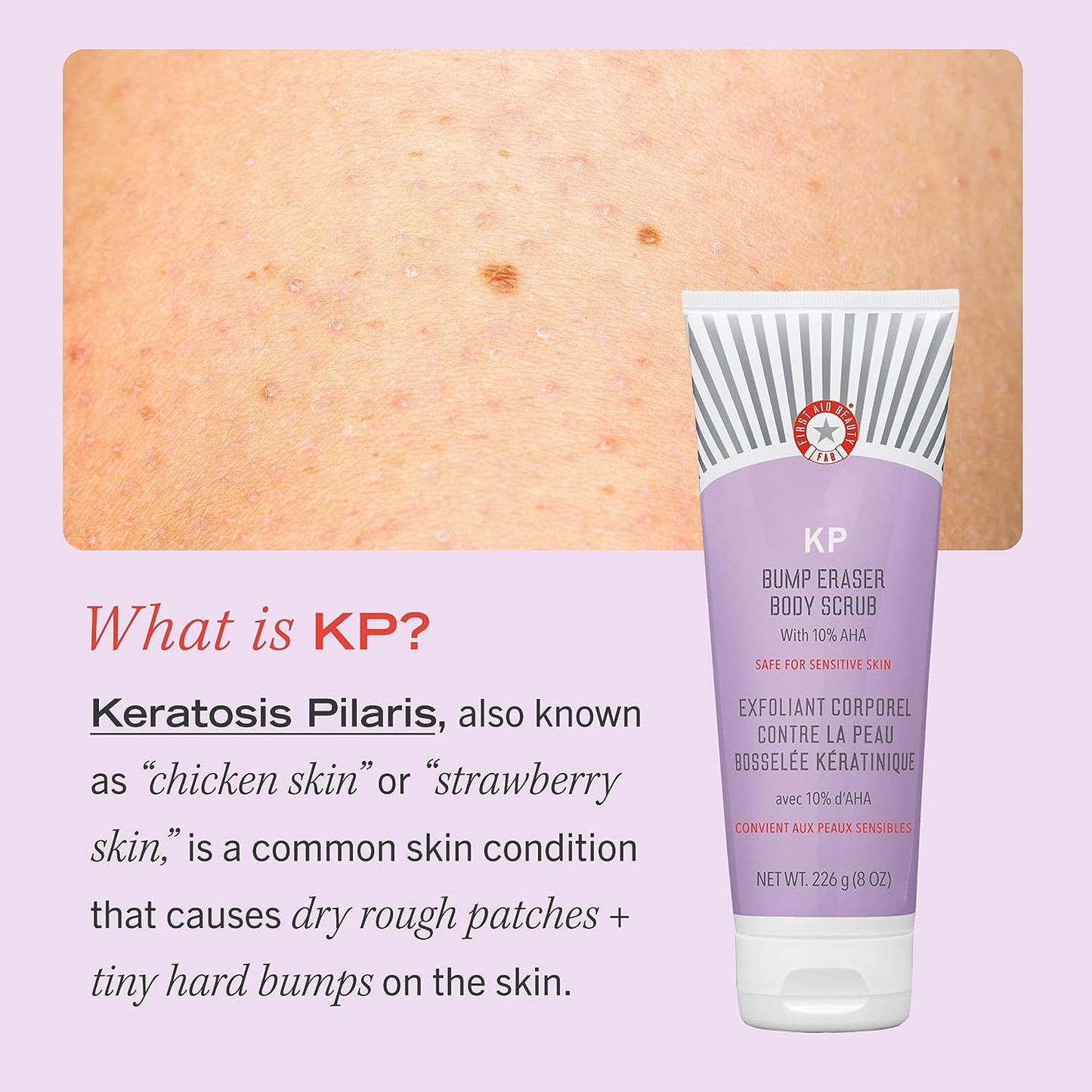 KP Bump Eraser Body Scrub Exfoliant for Keratosis Pilaris with 10% AHA 2 Oz.